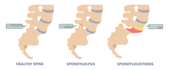 Spondylolysis